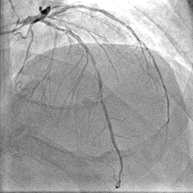 冠動脈カテーテル画像