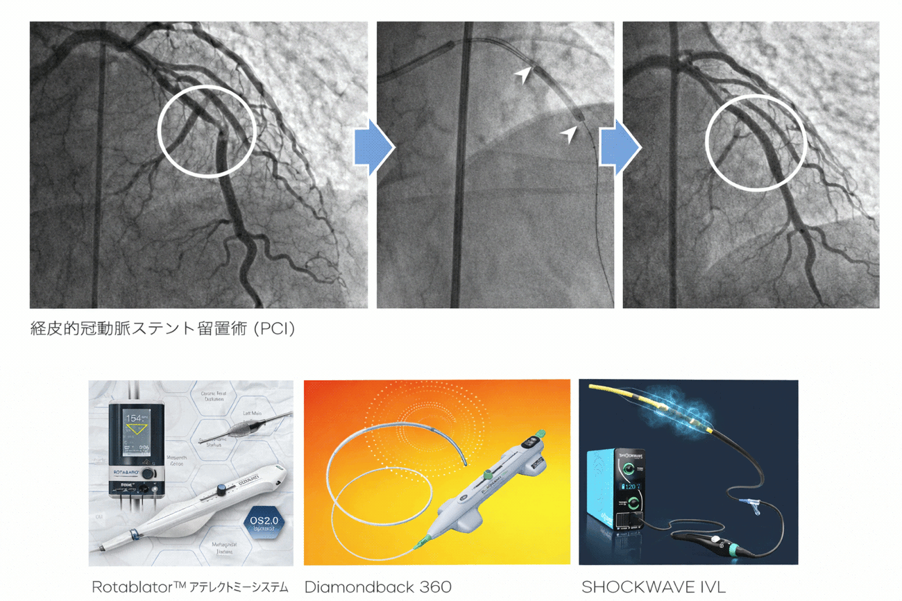 カテーテル治療
